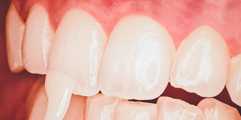 Fluoride Varnish for Stronger Teeth